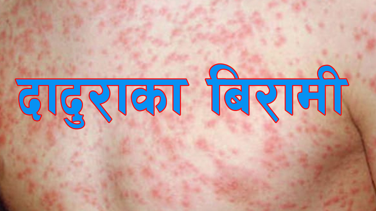 दादुराका ६७ बिरामी उपचारपछि घर फर्के, २० जनाको ‘आइसोलेसन’ उपचार जारी